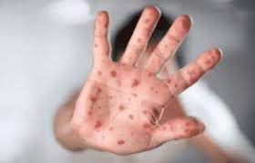 The results of the preliminary report of the three people suspected to be infected with the monkeypox virus in Karachi have come back negative.