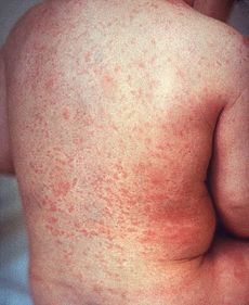 FALSE MEDIA REPORTS ON MEASLES DEATHS