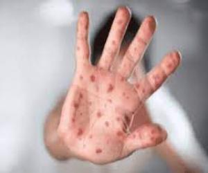The results of the preliminary report of the three people suspected to be infected with the monkeypox virus in Karachi have come back negative.