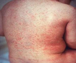 FALSE MEDIA REPORTS ON MEASLES DEATHS