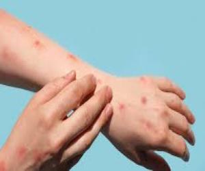 Karachi Confirms First Monkeypox Case in Sindh Province