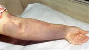 کوئٹہ سے  آنے والے ایک اور  شخص میں کانگو  وائرس کی تصدیق۔